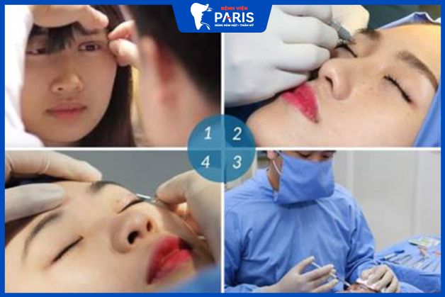 Quy trình thẩm mỹ khắc phục mắt diều đảm bảo đạt chuẩn Bộ Y tế.