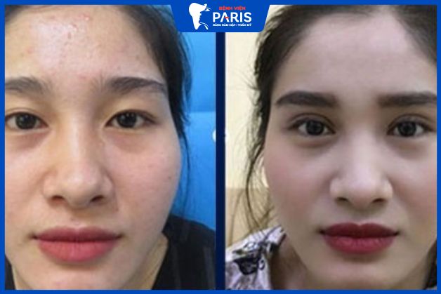 Trường hợp khách hàng mắt mí lót được khắc phục và tạo hình mắt phượng 2 mí cân đối