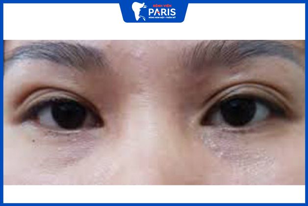 Trong trường hợp này không chỉ bác sĩ nhấn mí bị lệch cho khách hàng mà còn mắc lỗi khiến mắt có nhiều nếp mí