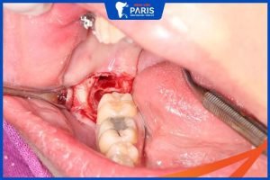Nhổ răng bao lâu thì lành, 4 yếu tố ảnh hưởng tới nhổ răng