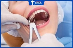 Nhổ răng cấm có bị chảy máu không, 5 Lưu ý sau khi nhổ răng