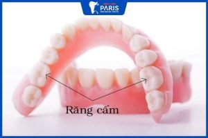 Nhổ răng cấm có mọc lại không – 3 phương pháp trồng răng cấm
