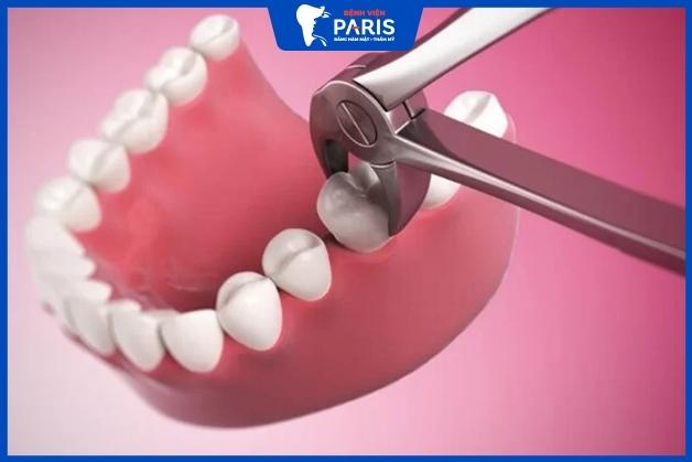 Nhổ răng có ảnh hưởng gì không