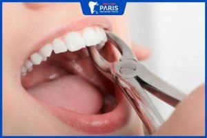 Nhổ răng có ảnh hưởng gì không – Làm gì để nhổ răng an toàn
