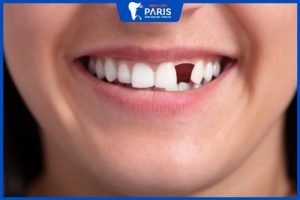 Nhổ răng cửa bao lâu thì trồng lại được, 5 Lưu ý sau khi nhổ