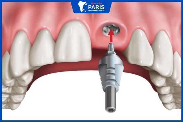 Trồng răng cửa bằng phương pháp cấy ghép Implant
