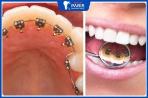 Niềng răng mặt trong có tốt không, 4 Phương pháp an toàn