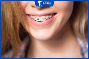 Niềng răng xong có nên tẩy trắng răng không – Giải đáp từ bác sĩ
