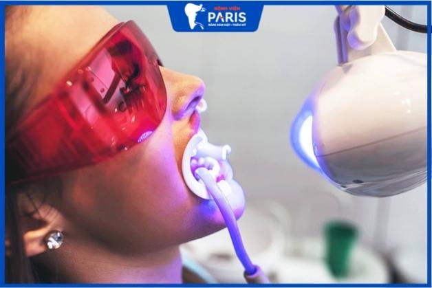 Tẩy trắng răng bằng tia laser
