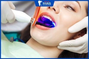 Tẩy trắng răng bằng đèn hợp quang – 6 Thông tin quan trọng
