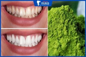 Tẩy trắng răng bằng trà xanh: Bật mí 4 cách an toàn, hiệu quả