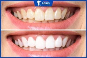 Tẩy trắng răng duy trì được bao lâu, 3 Cách giữ răng trắng sáng