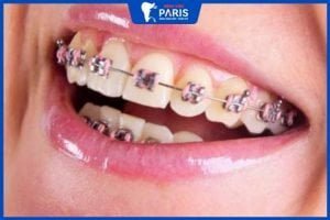 Tẩy trắng răng sau khi niềng – Những lời khuyên hữu ích