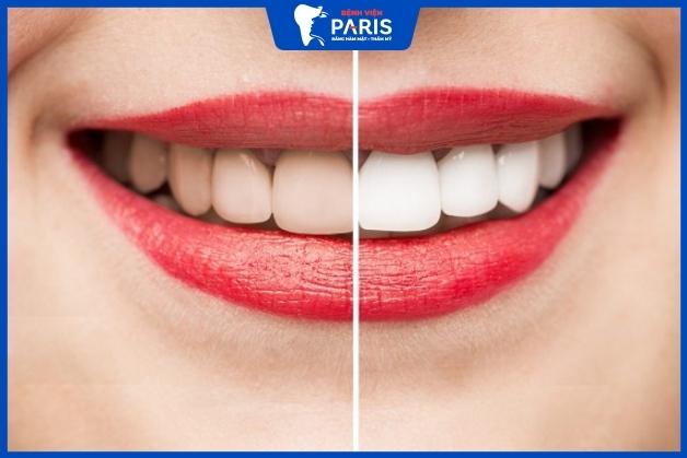 Công nghệ WhiteMax giúp răng trắng sáng bật tone ngay sau khi thực hiện