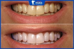 Tẩy trắng răng thời gian bao lâu? Địa chỉ tẩy trắng răng uy tín số 1