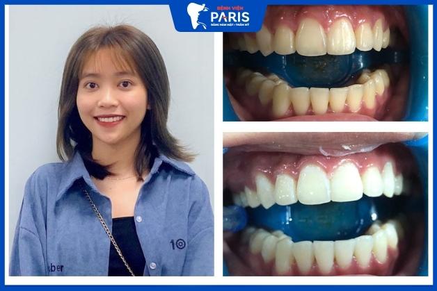 Tình trạng răng ố vàng biến mất hoàn toàn sau khi tẩy trắng