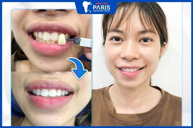 Khách hàng sau khi tẩy trắng răng