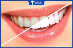 Tẩy trắng răng xong cần kiêng những gì? 4 Loại thực phẩm cần biết