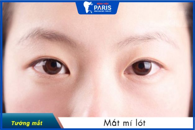Mắt mí lót hay còn gọi là mắt mí rưỡi, hoặc mắt hai mí ẩn