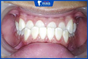 Chi phí chỉnh hàm móm bao nhiêu tiền, 3 yếu tố ảnh hưởng