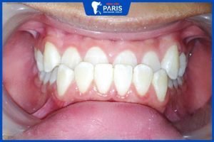 3 phương pháp chỉnh răng móm cho bé mà cha mẹ nên biết