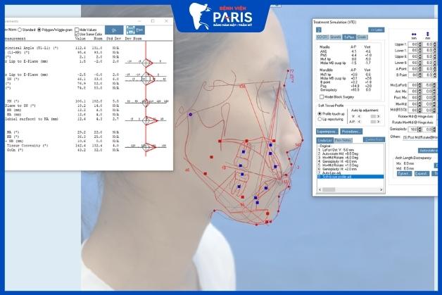 Công nghệ thẩm mỹ gọt hàm 3D tân tiến