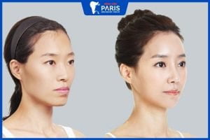 Hạ gò má có được vĩnh viễn không, cách chăm sóc giúp mau lành