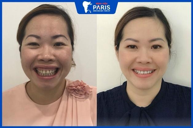 Khắc phục toàn diện các khuyết điểm và cải thiện chức năng ăn nhai