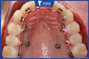 Bật mí 6 kinh nghiệm niềng răng mặt trong mà bạn nên biết