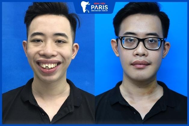 Những ca lột xác phẫu thuật hàm hô móm Nha khoa Paris