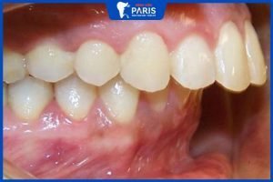 Phẫu thuật hàm hô có nguy hiểm không, Lưu ý quan trọng