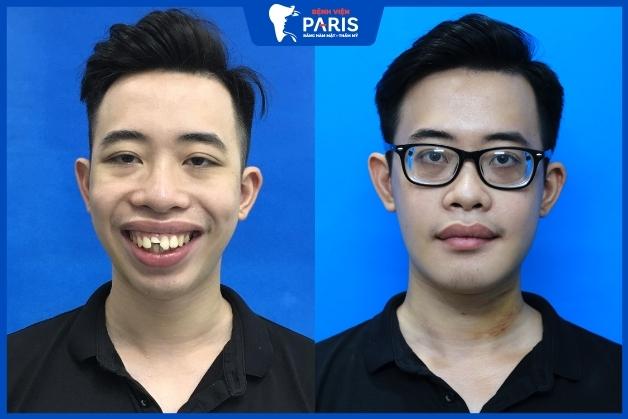 Khách hàng sau khi phẫu thuật hàm