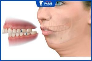 4 lưu ý khi lựa chọn đơn vị phẫu thuật hàm hô móm Hà Nội