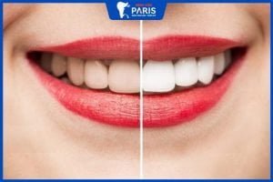 So sánh các phương pháp tẩy trắng răng được áp dụng nhiều nhất