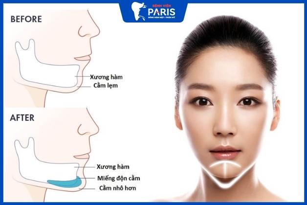 Thực hiện độn cằm bị lệch phải làm sao - Bác sĩ Joyce Nguyen tại Bệnh viện Paris trả lời