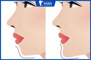 Phẫu thuật trượt cằm giá bao nhiêu tại BVRHM Paris
