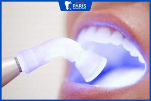 3 Ưu điểm của tẩy trắng răng bằng đèn Plasma bạn nên biết