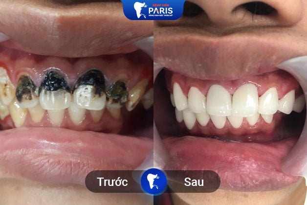 Khách hàng sau khi tẩy trắng răng WhiteMax