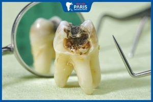 Bật mí 13 mẹo chữa đau răng sâu tại nhà đơn giản, hiệu quả