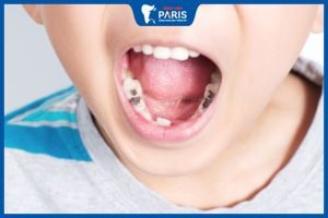 Bật mí 6 cách chữa sâu răng ở trẻ em tại nhà an toàn và hiệu quả