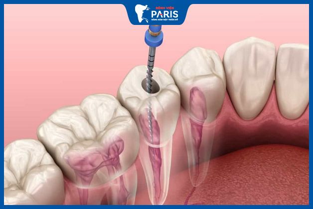 Có nên lấy tủy răng ở trẻ em không