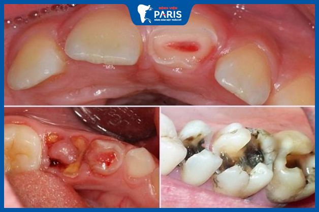 Hậu quả khi không chữa sâu răng triệt để
