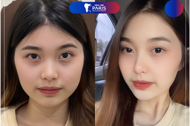 Hình ảnh trước và sau độn cằm