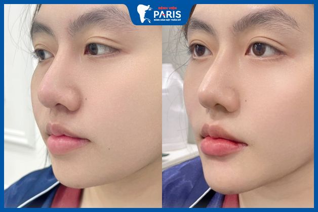 Hình ảnh trước và sau độn cằm