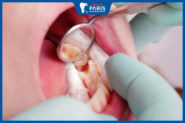 Hình ảnh viêm tủy răng ở trẻ