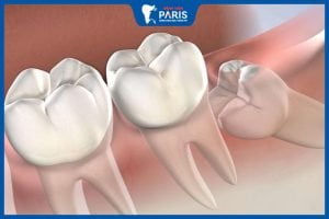 6 lưu ý quan trọng sau khi nhổ răng khôn bạn không thể bỏ qua
