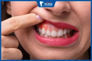 Sưng, đau nướu răng: 9 nguyên nhân và cách điều trị hiệu quả