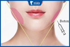 Góc hỏi – đáp: Tiêm botox gọn hàm bao lâu thì tiêm lại được
