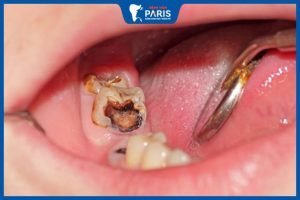 Trẻ bị sâu răng ăn vào tủy: Dấu hiệu, cách điều trị hiệu quả