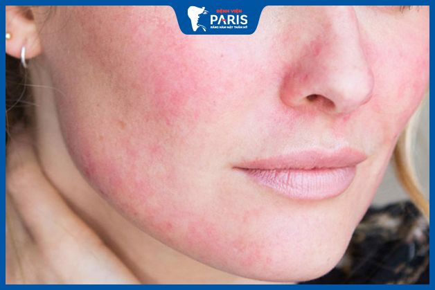 Biến chứng bạn có thể gặp phải khi tiêm hạ gò má